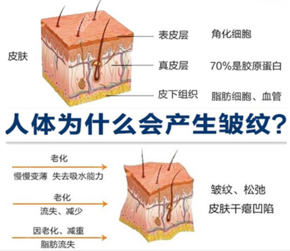 产生皱纹的原因