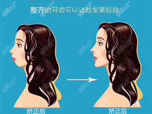 矫正牙齿前后对比图