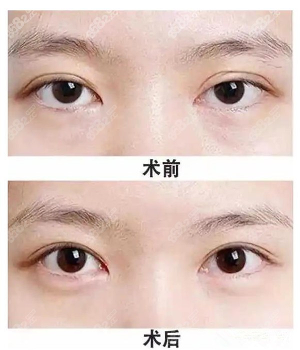 韩国大眼睛双眼皮修复实例及价格明细汇总都评价技术好