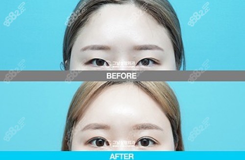 韩国歌娜整形外科双眼皮整形前后