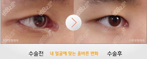 韩国眼睛修复对比照