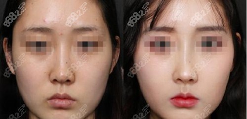 韩国Thenan整形外科隆鼻好看的图片