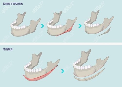 下颌角手术方式有哪些