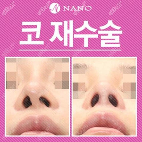 韩国nano整形外科鼻修复案例
