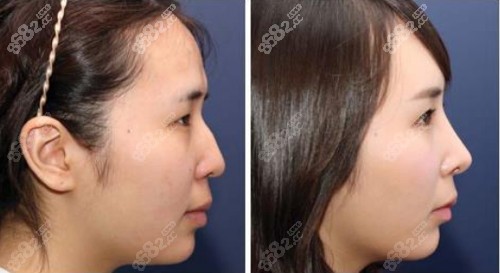 韩国nano整形外科鼻整形前后对比