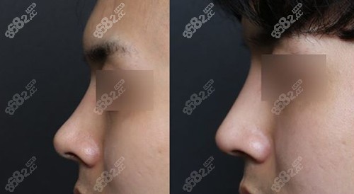 男性翘鼻改直鼻对比