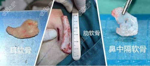 三种自体软骨示意图