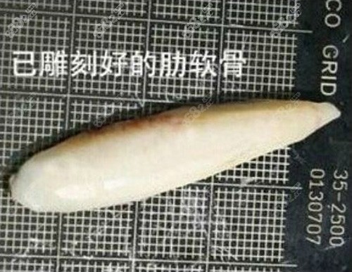 雕刻好的肋软骨