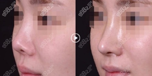 韩国Thenan整形外科自体软骨隆鼻尖案例