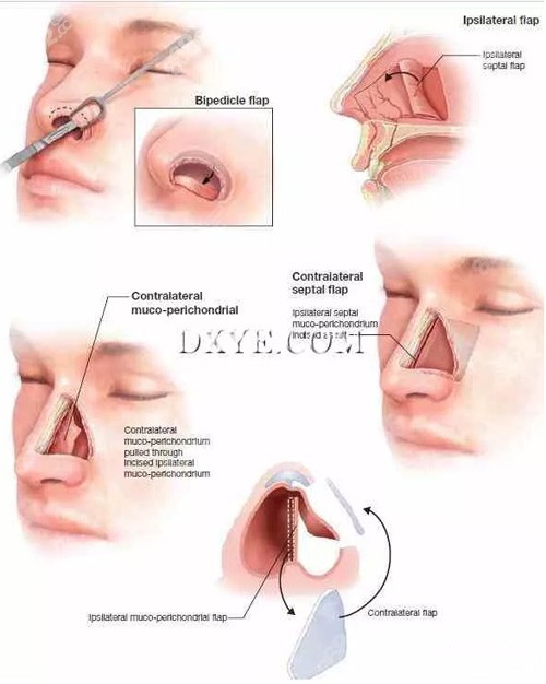 鼻中隔手术图解图片