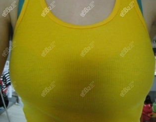 韩国普罗菲耳隆胸后的照片