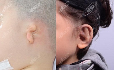 韩国普罗菲耳整形医院外耳再造手术实例