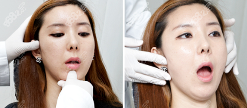 侧脸月牙脸怎么改善
