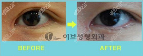 韩国eve修复内眼角案例