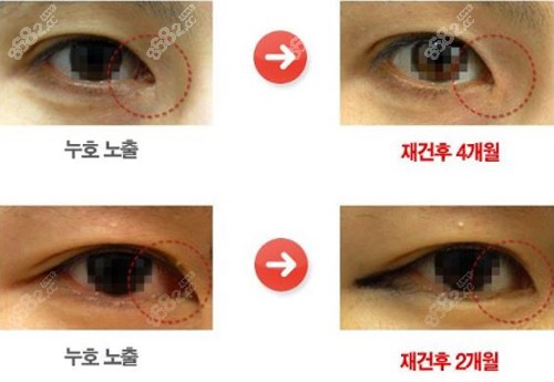 韩国eve修复内眼角案例对比