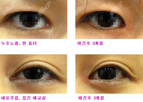 韩国EVE整形外科眼角修复案例