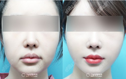 韩国歌娜整形外科迷你拉皮+面吸真人对比照