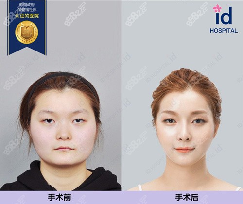 韩国ID整形医院下颌角手术前后对比照