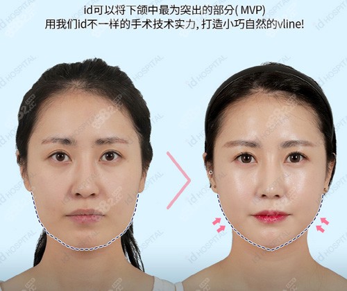 韩国ID整形医院下颌角整形案例