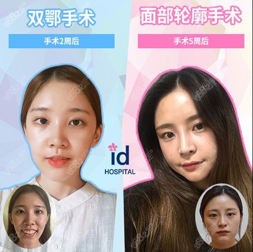韩国ID医院面部轮廓及双鄂手术案例