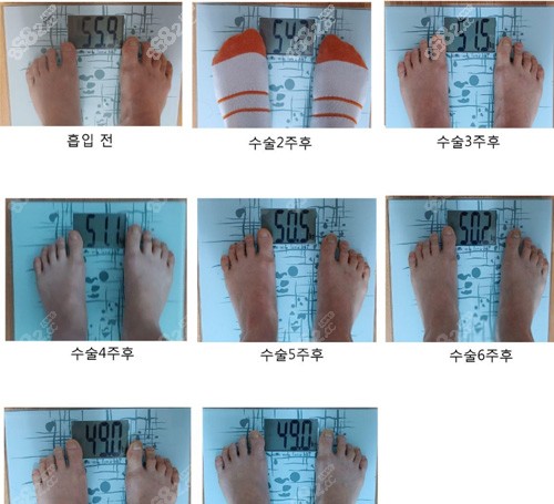 韩国365mc医院腰腹环吸前后体重变化