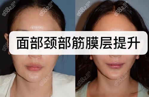 韩国BIO医院面部颈部拉皮手术案例