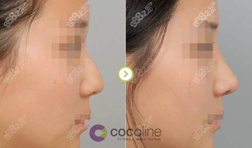 韩国Cocoline整形外科鼻整形对比照