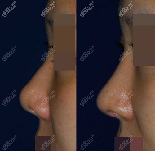 韩国Rococo整形外科鼻整形案例