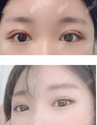 韩国LaForet整形医院双眼皮手术后恢复期图