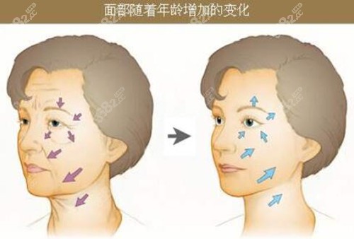 用医美除皱抗衰方式改善面部皮肤衰老问题