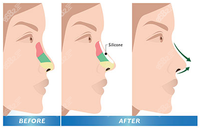泰国yanhee医院隆鼻手术过程图片