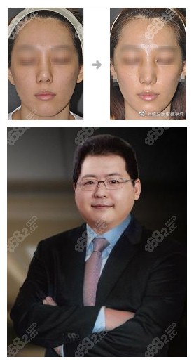 韩国WILL整形医院鼻修复