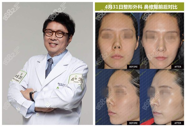 韩国4月31日整形医院鼻修复