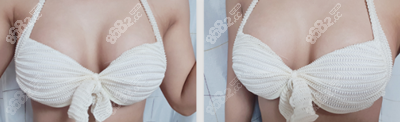 韩国NANA整形外科隆胸修复对比照