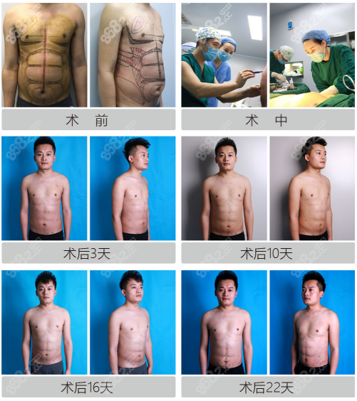 北京韩啸威塑吸脂吸出腹肌案例过程图