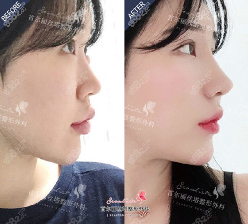 韩国丽丝塔seoulista整形外科鼻整形案例