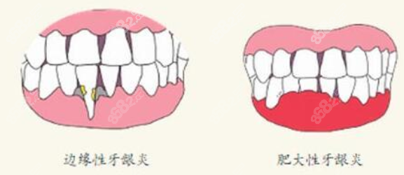 牙龈炎类型