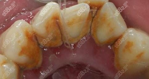 牙龈炎后期