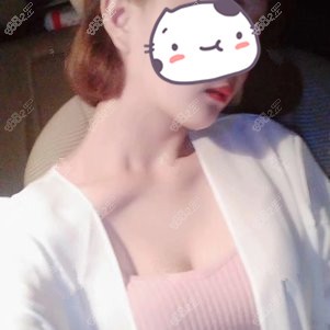 重庆华美张梅医生假体隆胸案例