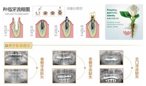 种植牙手术流程图