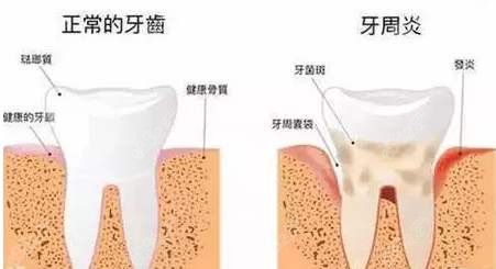 牙周炎前期和晚期