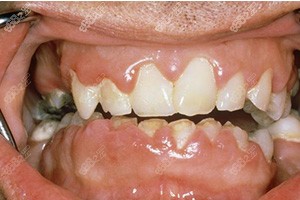 牙周病引起的牙齿缺损现象