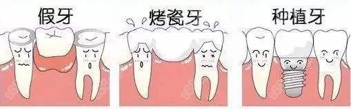 假牙和种植牙对比