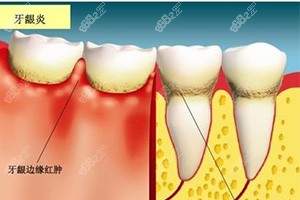 牙龈炎初期会有什么症状？