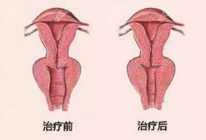 阴道紧缩手术术前术后对比效果照