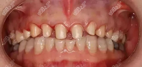 牙齿矫正后期牙齿会脱落吗
