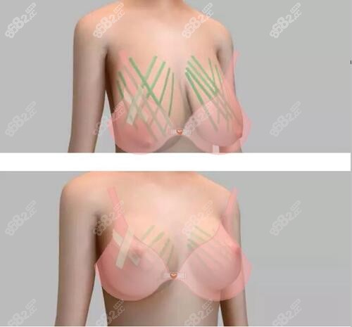 人工韧带乳房上提手术操作过程