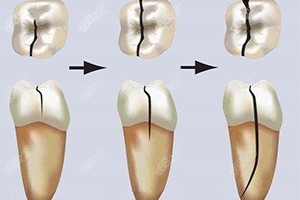 牙齿裂缝该如何进行修复？