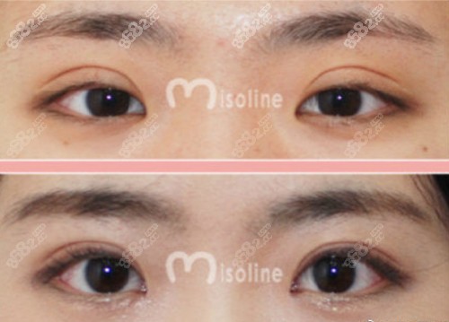  韩国Misoline整形医院双眼皮案例