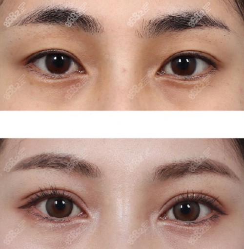 韩国1mm整形外科双眼皮前后对比